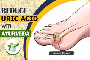Best Ayurvedic Medicine For Uric Acid