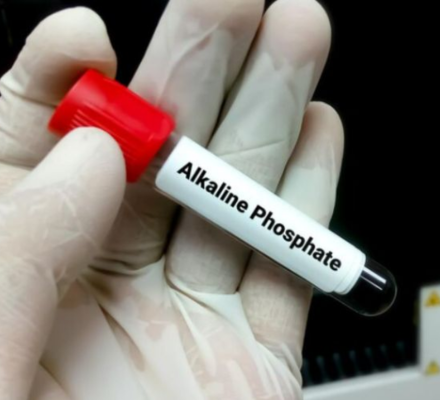 4 Foods to Avoid if Alkaline Phosphatase is High, what foods to avoid if alkaline phosphatase is high, diet for high alkaline phosphatase, high alkaline phosphatase and high white blood count